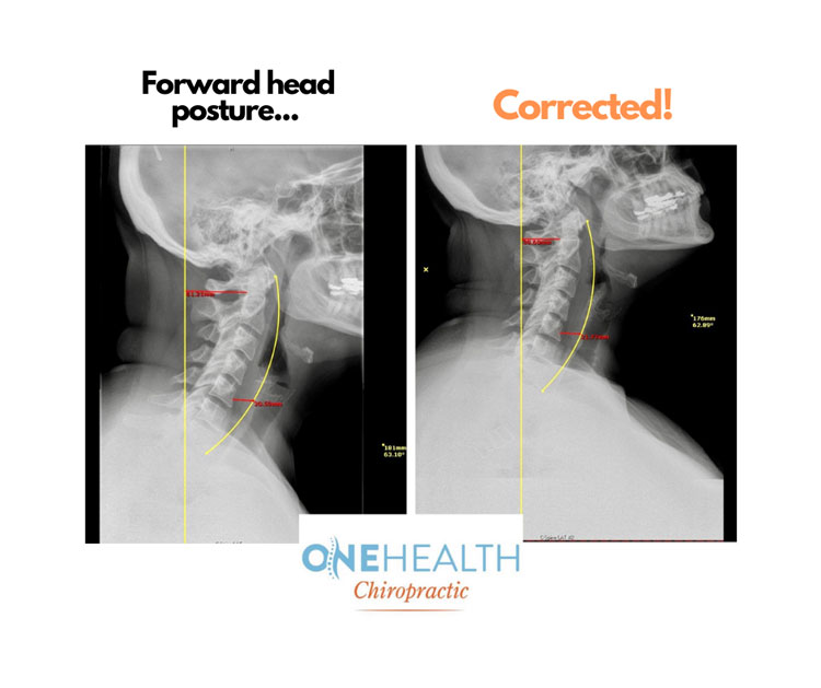 Chiropractic Oklahoma City OK Forward Head Posture